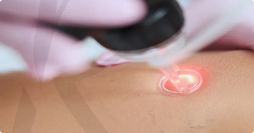 Imagem Tratamento para Varizes e Vasinhos a Laser