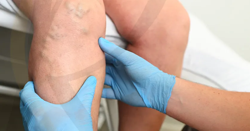Cryo-Escleroterapia + Cryo-Laser Imagem Cryo-Escleroterapia + Cryo-Laser